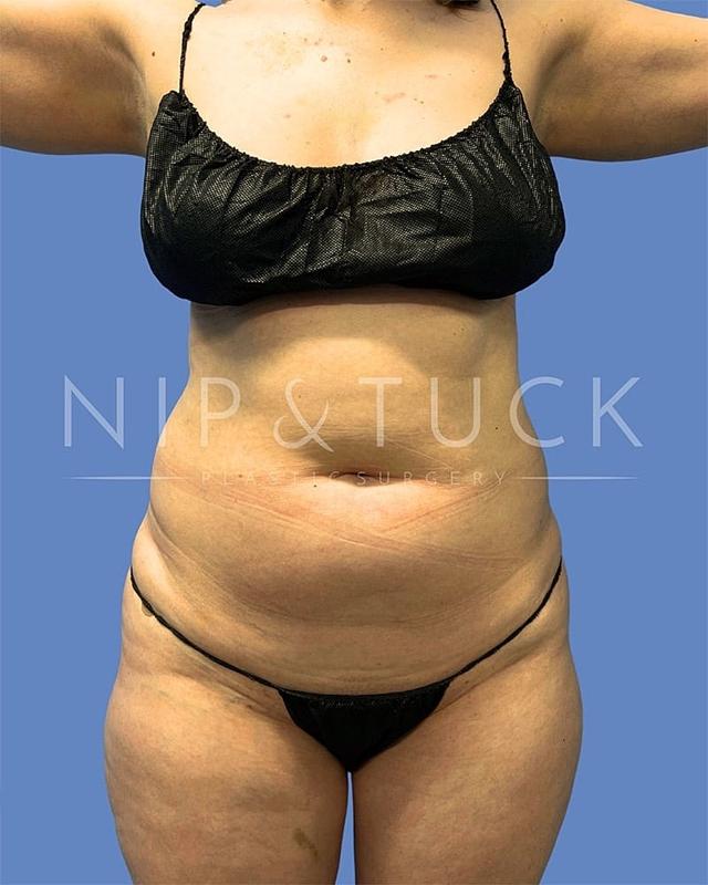 Mommy Makeover before at Dr. Nip and Tuck (Plastic Surgery Inst) in Atlanta, GA