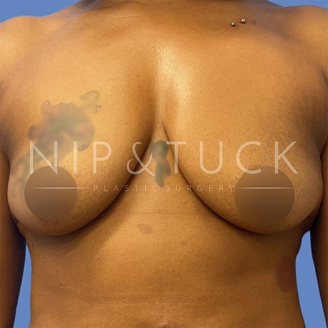 Breast Augmentation before at Dr. Nip and Tuck (Plastic Surgery Inst) in Atlanta, GA