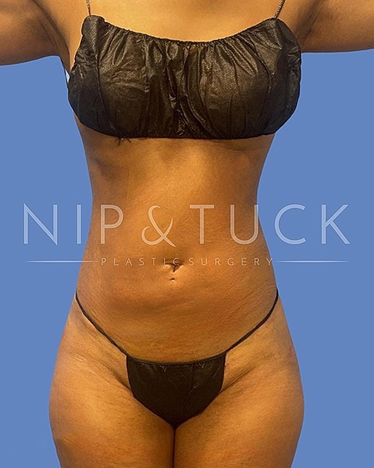 Dr. Nip and Tuck (Plastic Surgery Inst) bbl after — Atlanta, GA