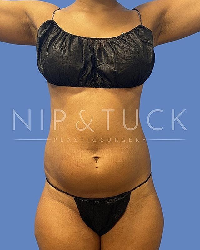 Brazilian Butt Lift before at Dr. Nip and Tuck (Plastic Surgery Inst) in Atlanta, GA