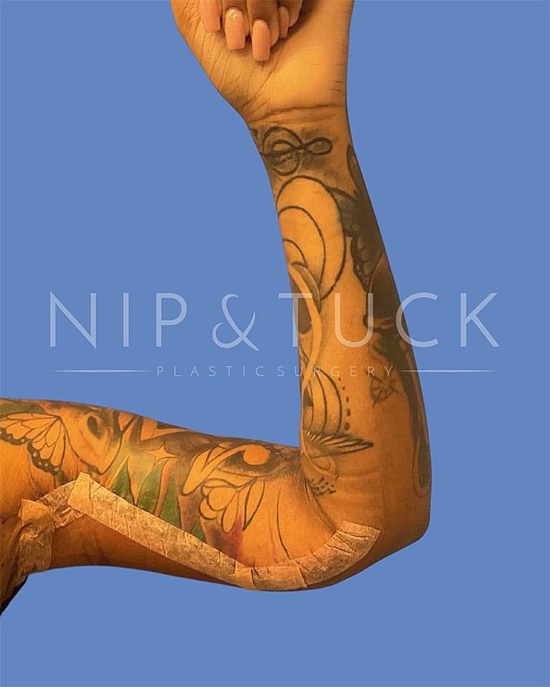 Dr. Nip and Tuck (Plastic Surgery Inst) arm lift after — Atlanta, GA