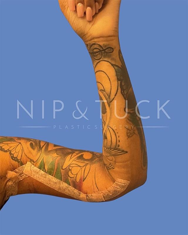 Arm Lift after at Dr. Nip and Tuck (Plastic Surgery Inst) in Atlanta, GA