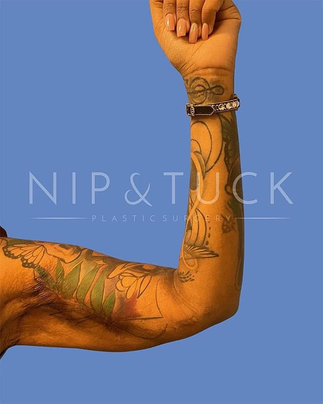 Arm Lift before at Dr. Nip and Tuck (Plastic Surgery Inst) in Atlanta, GA