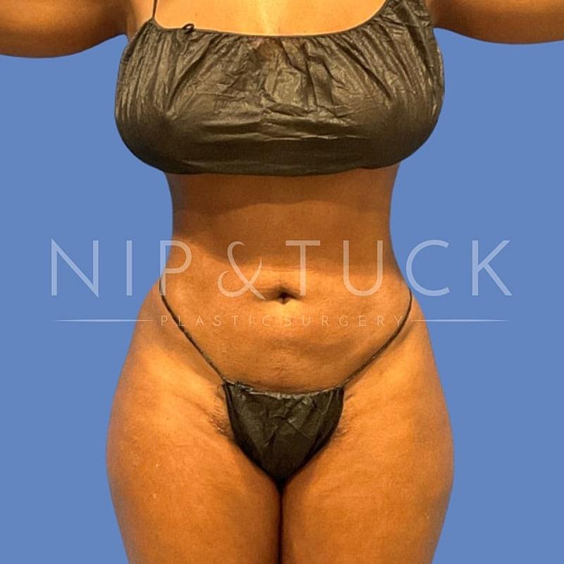 Dr. Nip and Tuck (Plastic Surgery Inst) liposuction after — Atlanta, GA