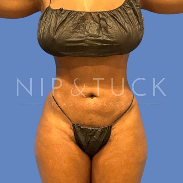 Liposuction after at Dr. Nip and Tuck (Plastic Surgery Inst) in Atlanta, GA