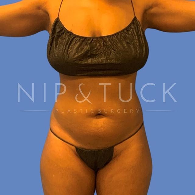 Liposuction before at Dr. Nip and Tuck (Plastic Surgery Inst) in Atlanta, GA