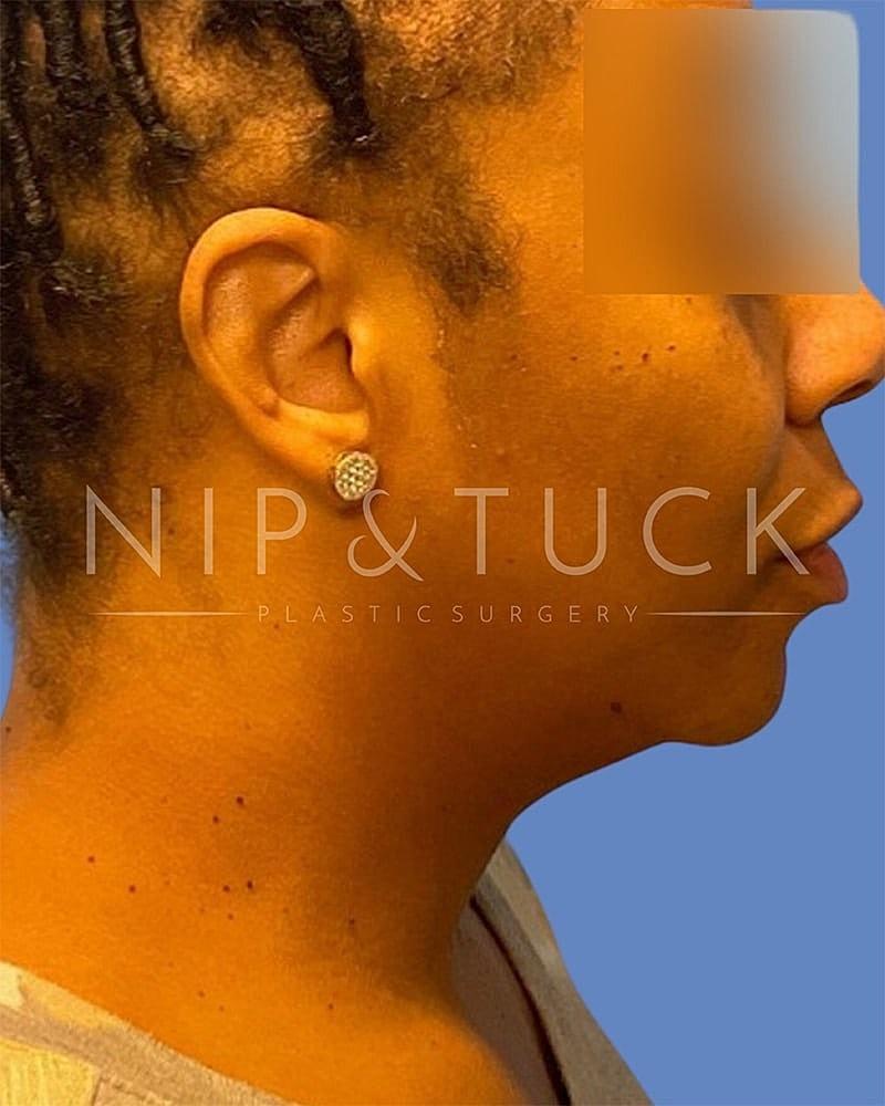 Dr. Nip and Tuck (Plastic Surgery Inst) liposuction after — Atlanta, GA