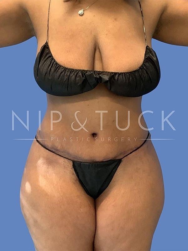 Dr. Nip and Tuck (Plastic Surgery Inst) tummy tuck after — Atlanta, GA