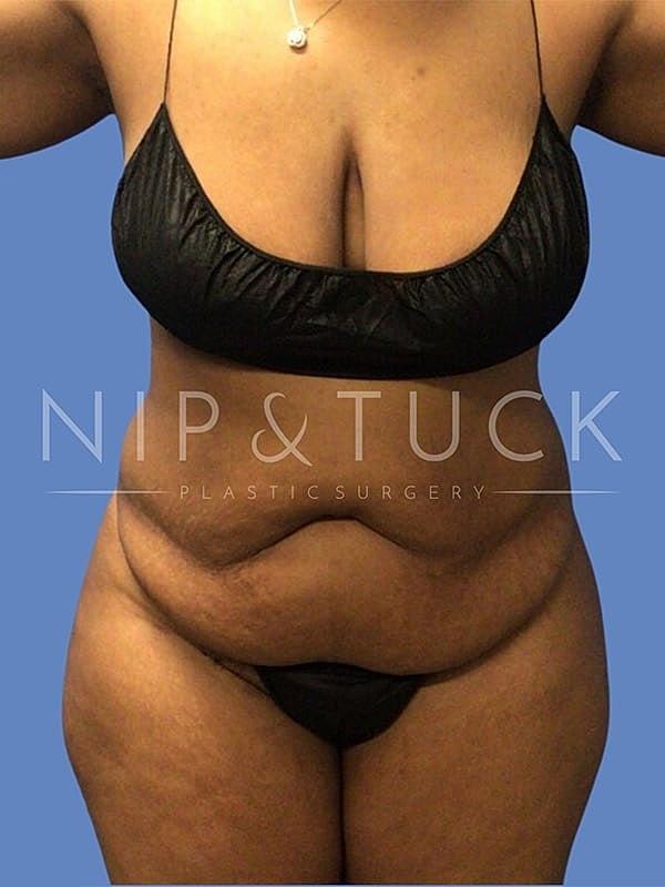 Tummy Tuck before at Dr. Nip and Tuck (Plastic Surgery Inst) in Atlanta, GA