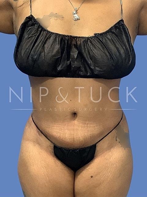 Dr. Nip and Tuck (Plastic Surgery Inst) tummy tuck after — Atlanta, GA