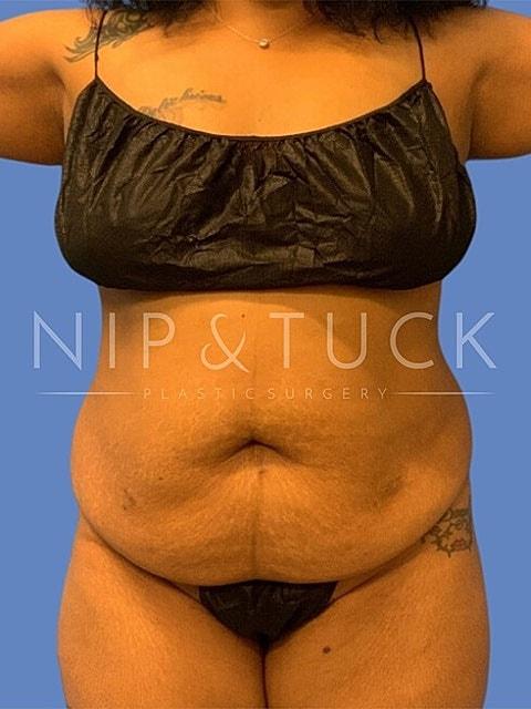 Tummy Tuck before at Dr. Nip and Tuck (Plastic Surgery Inst) in Atlanta, GA