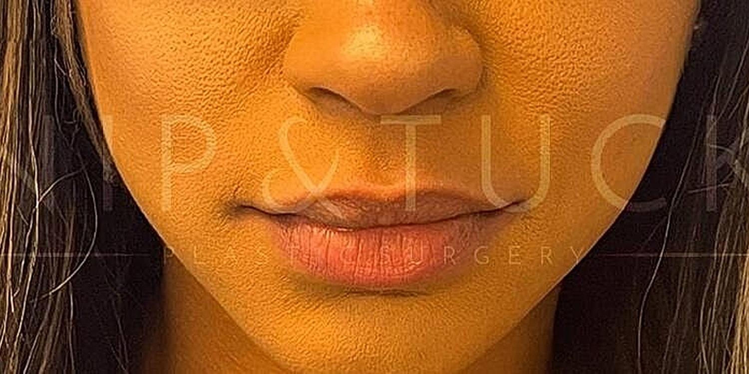 Dr. Nip and Tuck (Plastic Surgery Inst) lip filler result — Atlanta, GA