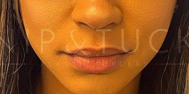 Lip Filler result at Dr. Nip and Tuck (Plastic Surgery Inst) in Atlanta, GA