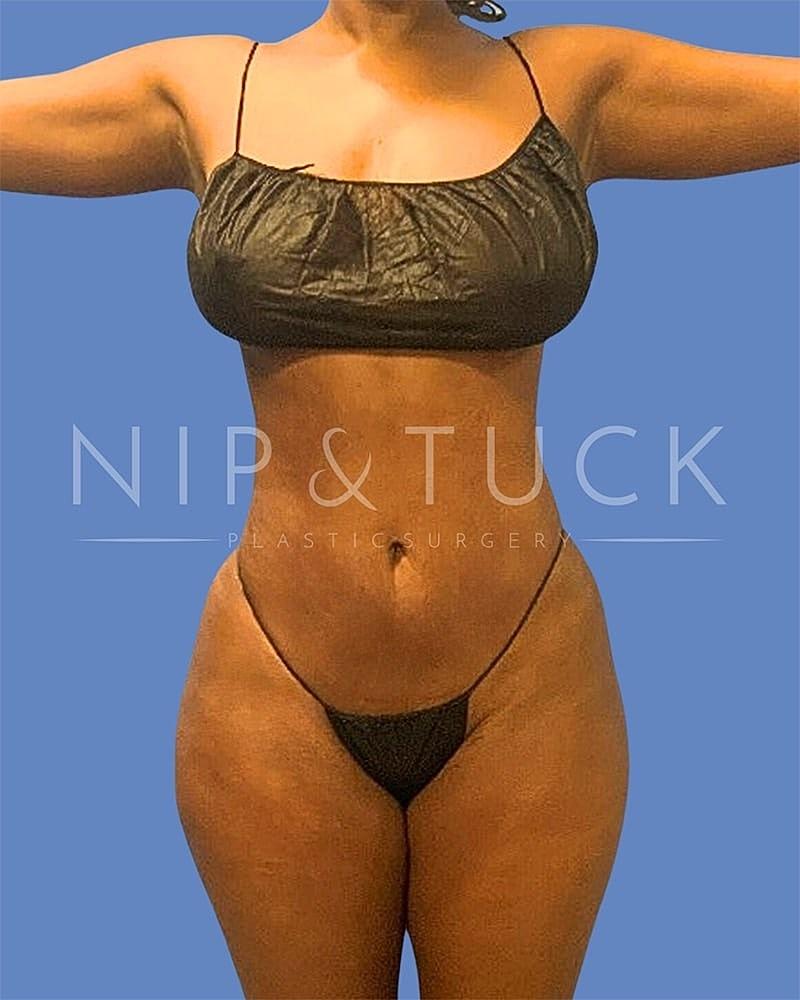 Dr. Nip and Tuck (Plastic Surgery Inst) bbl after — Atlanta, GA