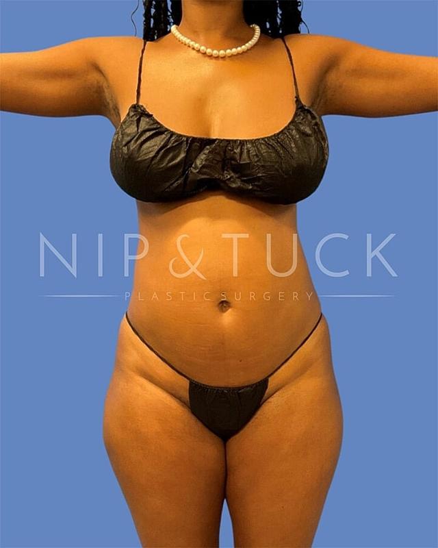 Brazilian Butt Lift before at Dr. Nip and Tuck (Plastic Surgery Inst) in Atlanta, GA
