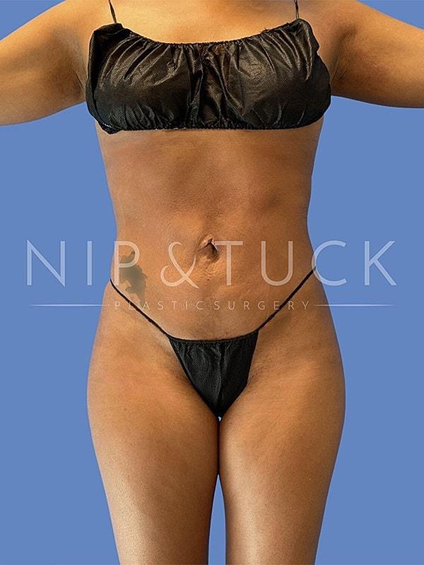 Dr. Nip and Tuck (Plastic Surgery Inst) bbl after — Atlanta, GA