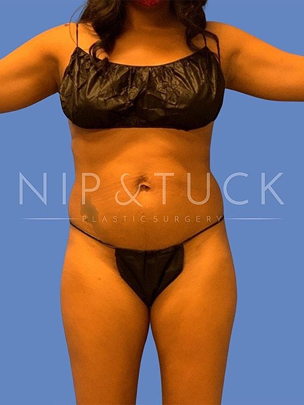 Brazilian Butt Lift before at Dr. Nip and Tuck (Plastic Surgery Inst) in Atlanta, GA