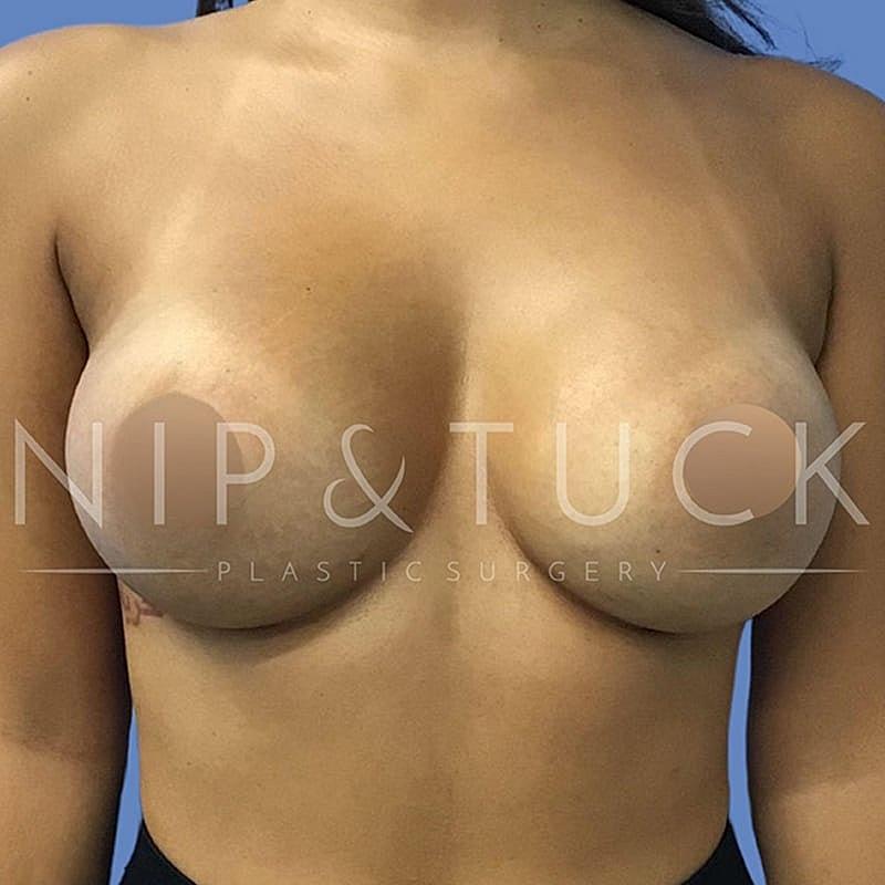 Dr. Nip and Tuck (Plastic Surgery Inst) breast augmentation after — Atlanta, GA