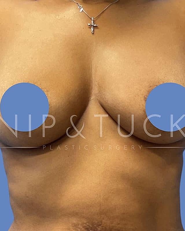 Mommy Makeover before at Dr. Nip and Tuck (Plastic Surgery Inst) in Atlanta, GA