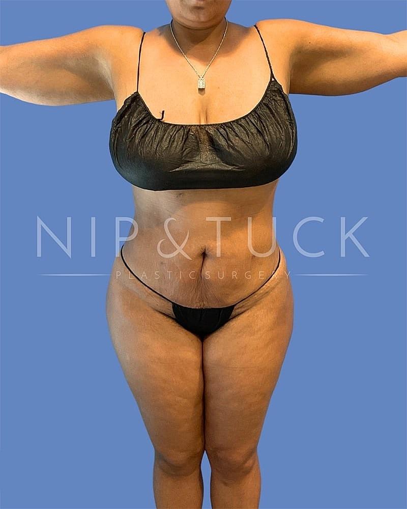 Dr. Nip and Tuck (Plastic Surgery Inst) mommy makeover after — Atlanta, GA