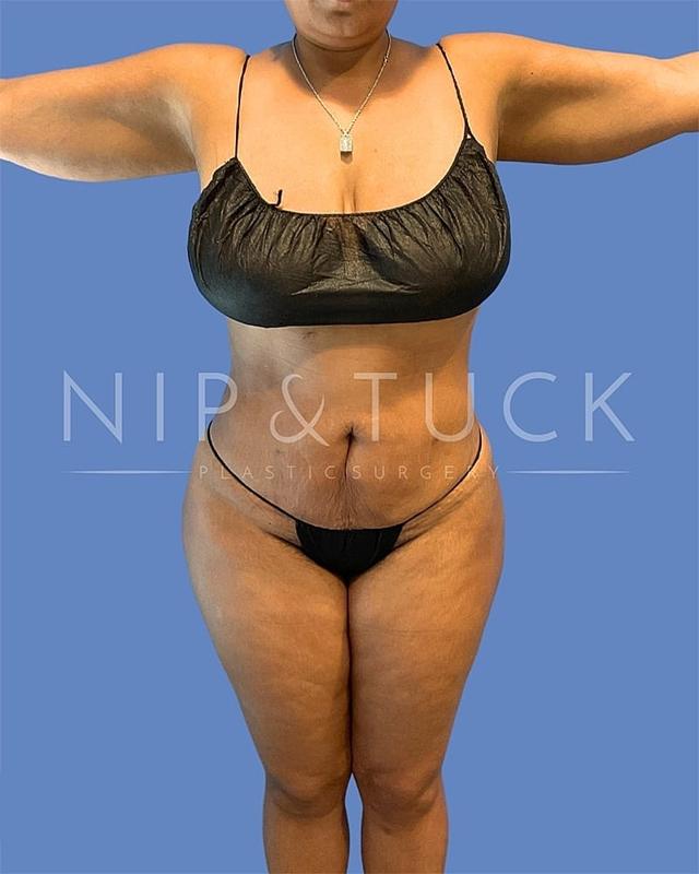 Mommy Makeover after at Dr. Nip and Tuck (Plastic Surgery Inst) in Atlanta, GA