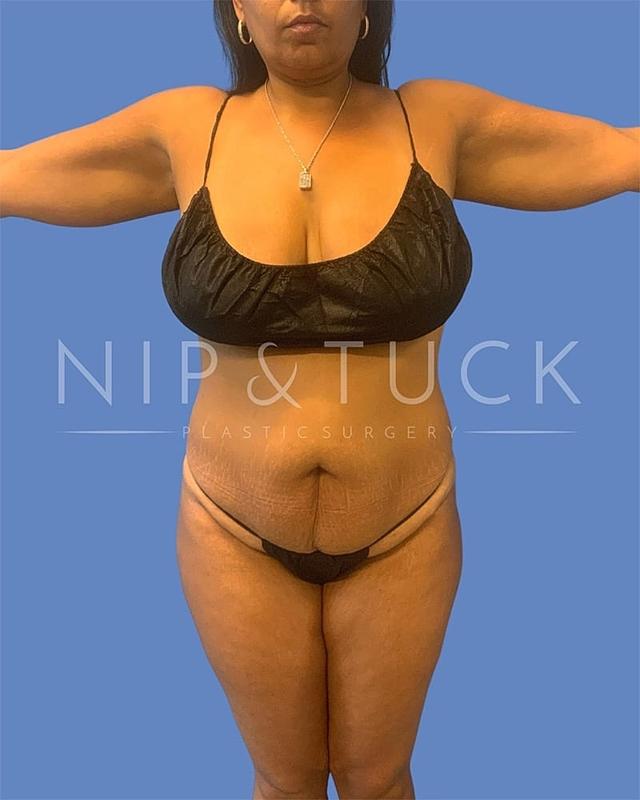 Mommy Makeover before at Dr. Nip and Tuck (Plastic Surgery Inst) in Atlanta, GA