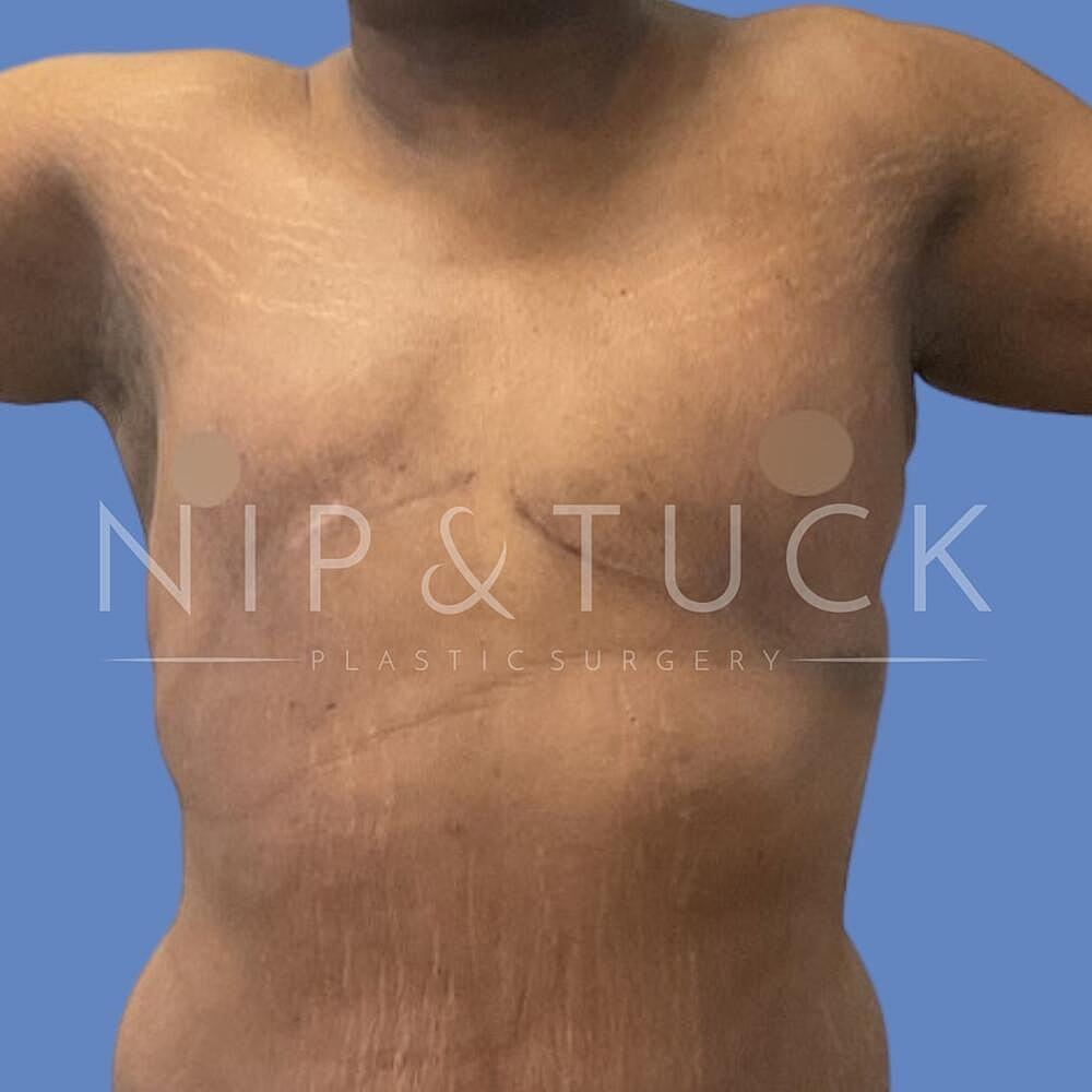Dr. Nip and Tuck (Plastic Surgery Inst) gynecomastia after — Atlanta, GA