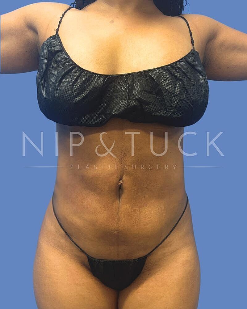 Dr. Nip and Tuck (Plastic Surgery Inst) liposuction after — Atlanta, GA