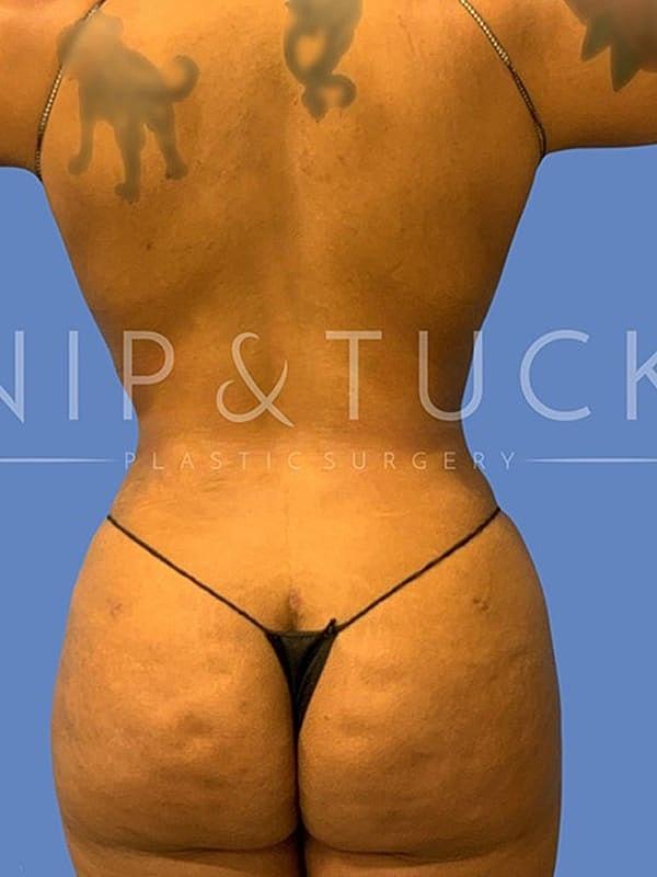 Dr. Nip and Tuck (Plastic Surgery Inst) bbl after — Atlanta, GA