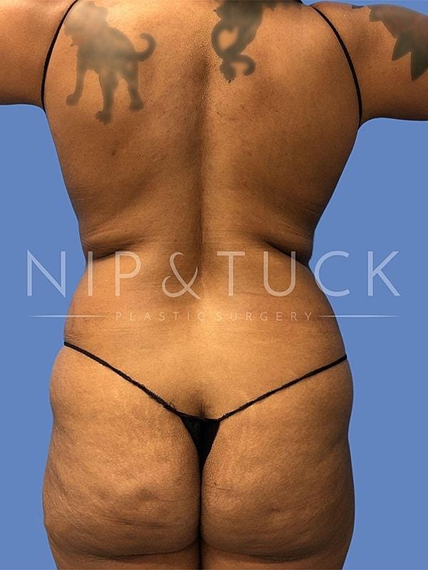Brazilian Butt Lift before at Dr. Nip and Tuck (Plastic Surgery Inst) in Atlanta, GA