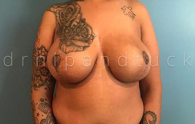 Breast Reduction after at Dr. Nip and Tuck (Plastic Surgery Inst) in Atlanta, GA