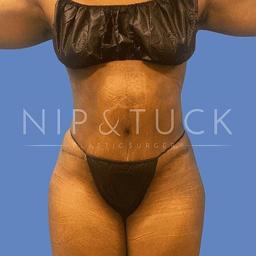 Dr. Nip and Tuck (Plastic Surgery Inst) brazilian butt lift result