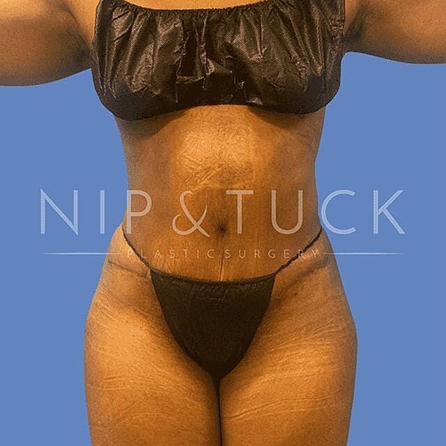 Liposuction after at Dr. Nip and Tuck (Plastic Surgery Inst) in Atlanta, GA