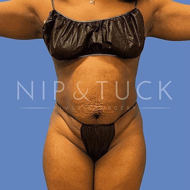 Liposuction before at Dr. Nip and Tuck (Plastic Surgery Inst) in Atlanta, GA