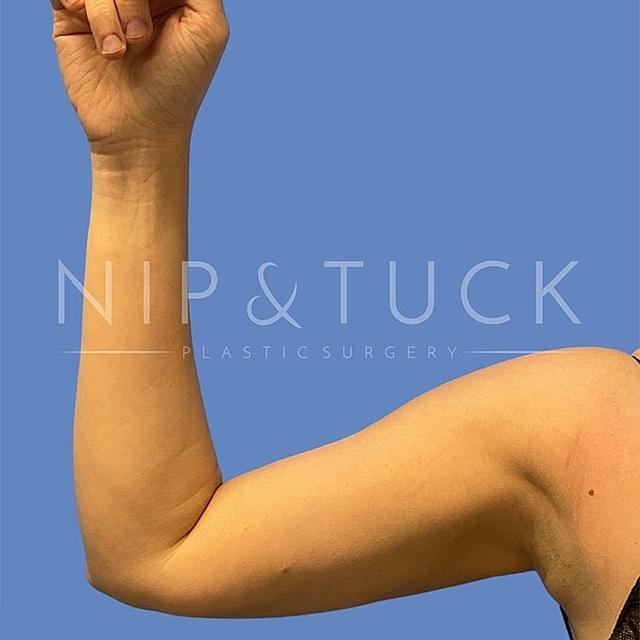 Arm Lift after at Dr. Nip and Tuck (Plastic Surgery Inst) in Atlanta, GA