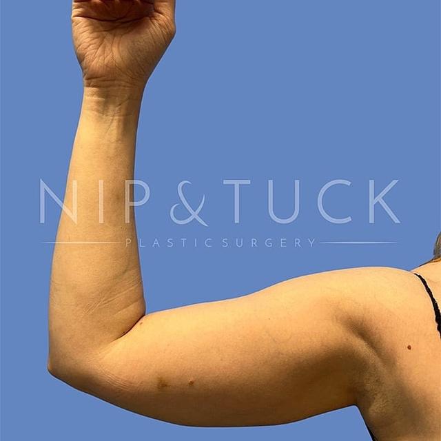 Arm Lift before at Dr. Nip and Tuck (Plastic Surgery Inst) in Atlanta, GA