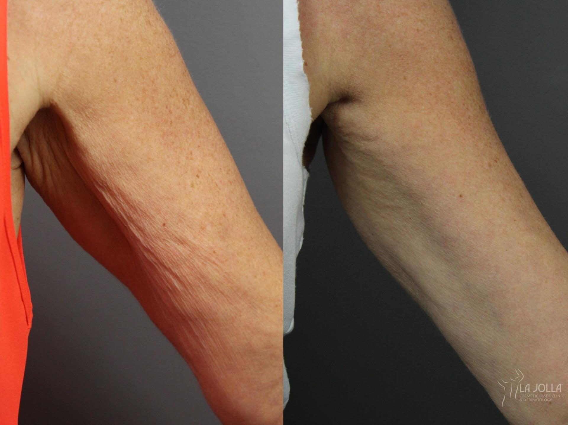 La Jolla Cosmetic Laser Clinic & Dermatology skin tightening result — San Diego, CA