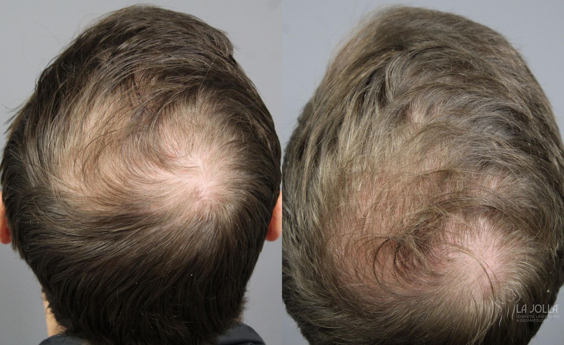 La Jolla Cosmetic Laser Clinic & Dermatology prp hair result — San Diego, CA