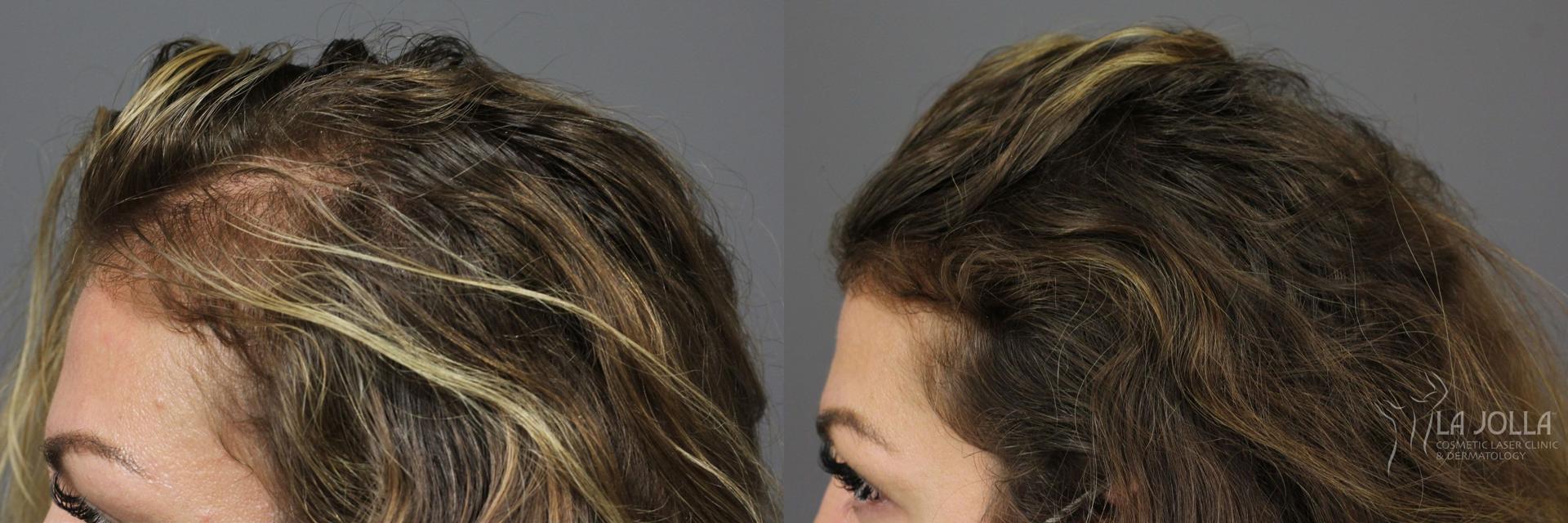 La Jolla Cosmetic Laser Clinic & Dermatology prp hair result — San Diego, CA