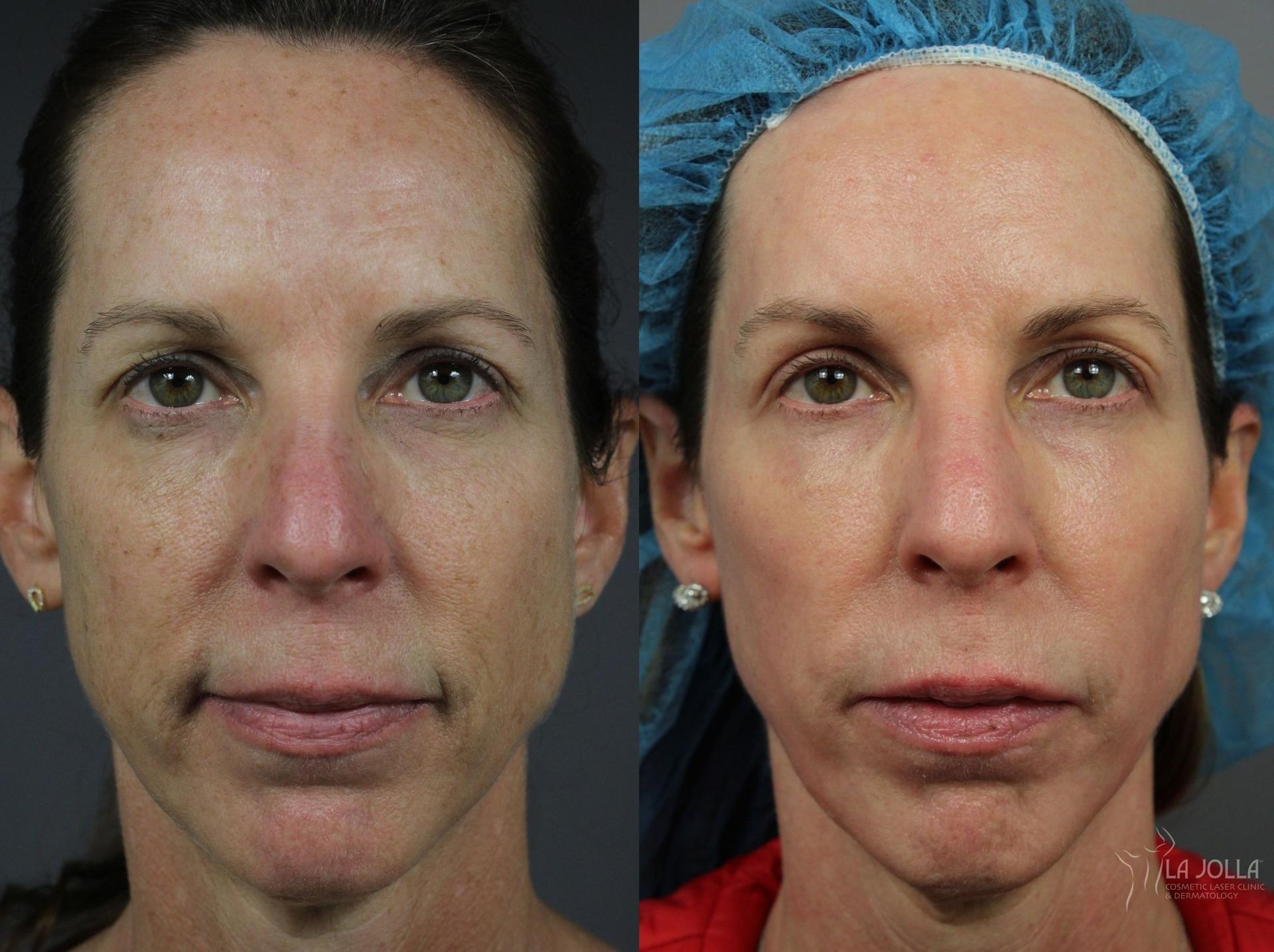 La Jolla Cosmetic Laser Clinic & Dermatology laser treatment result — San Diego, CA