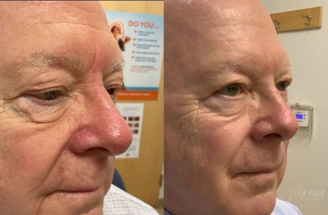 Laser Skin Resurfacing result at La Jolla Cosmetic Laser Clinic & Dermatology in San Diego, CA