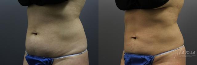 CoolSculpting result at La Jolla Cosmetic Laser Clinic & Dermatology in San Diego, CA