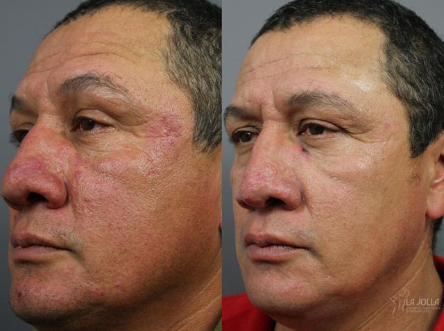Laser Skin Resurfacing result at La Jolla Cosmetic Laser Clinic & Dermatology in San Diego, CA