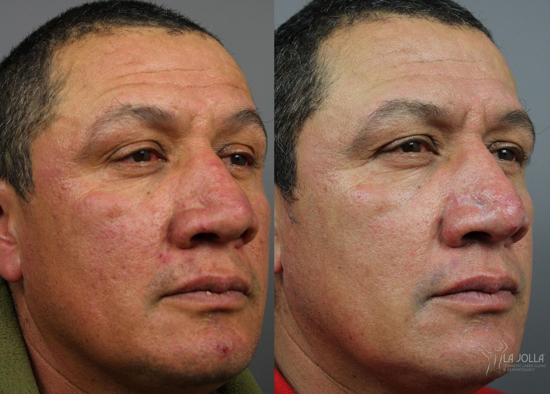 La Jolla Cosmetic Laser Clinic & Dermatology laser treatment result — San Diego, CA