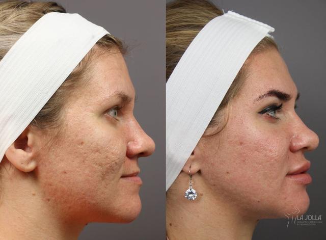 Lip Filler result at La Jolla Cosmetic Laser Clinic & Dermatology in San Diego, CA