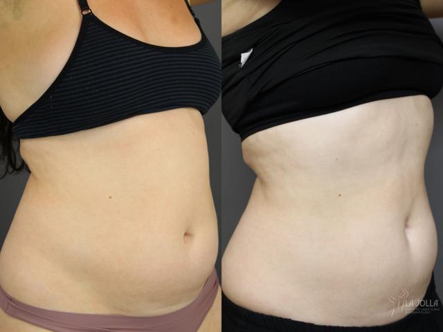 CoolSculpting result at La Jolla Cosmetic Laser Clinic & Dermatology in San Diego, CA