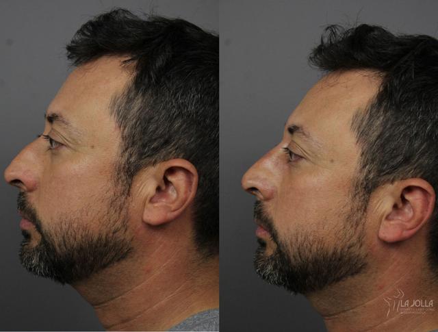 Functional Rhinoplasty result at La Jolla Cosmetic Laser Clinic & Dermatology in San Diego, CA