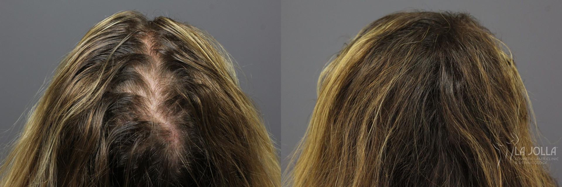 La Jolla Cosmetic Laser Clinic & Dermatology prp hair result — San Diego, CA
