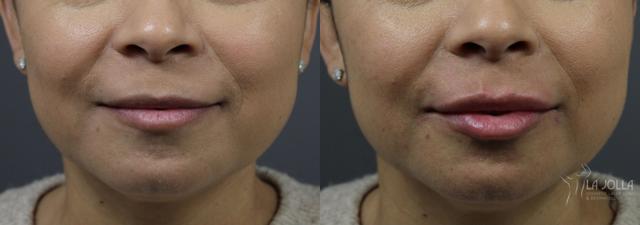 Lip Filler result at La Jolla Cosmetic Laser Clinic & Dermatology in San Diego, CA