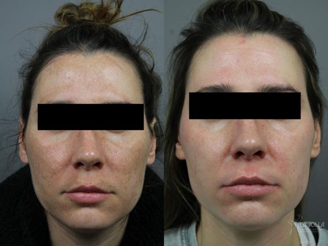 Chemical Peel result at La Jolla Cosmetic Laser Clinic & Dermatology in San Diego, CA
